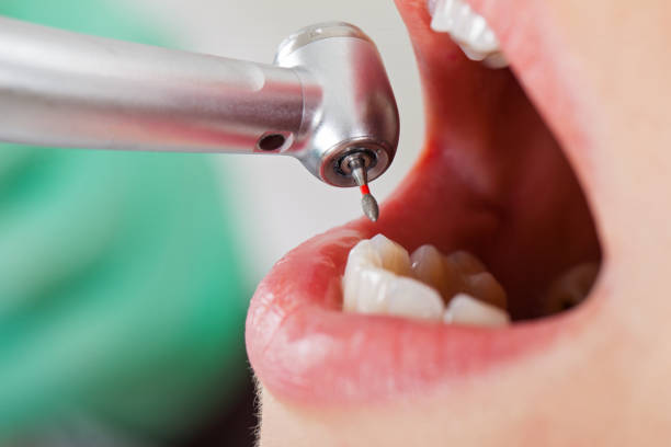 Best Emergency Treatment for Dental Infections or Abscesses in Brielle, NJ